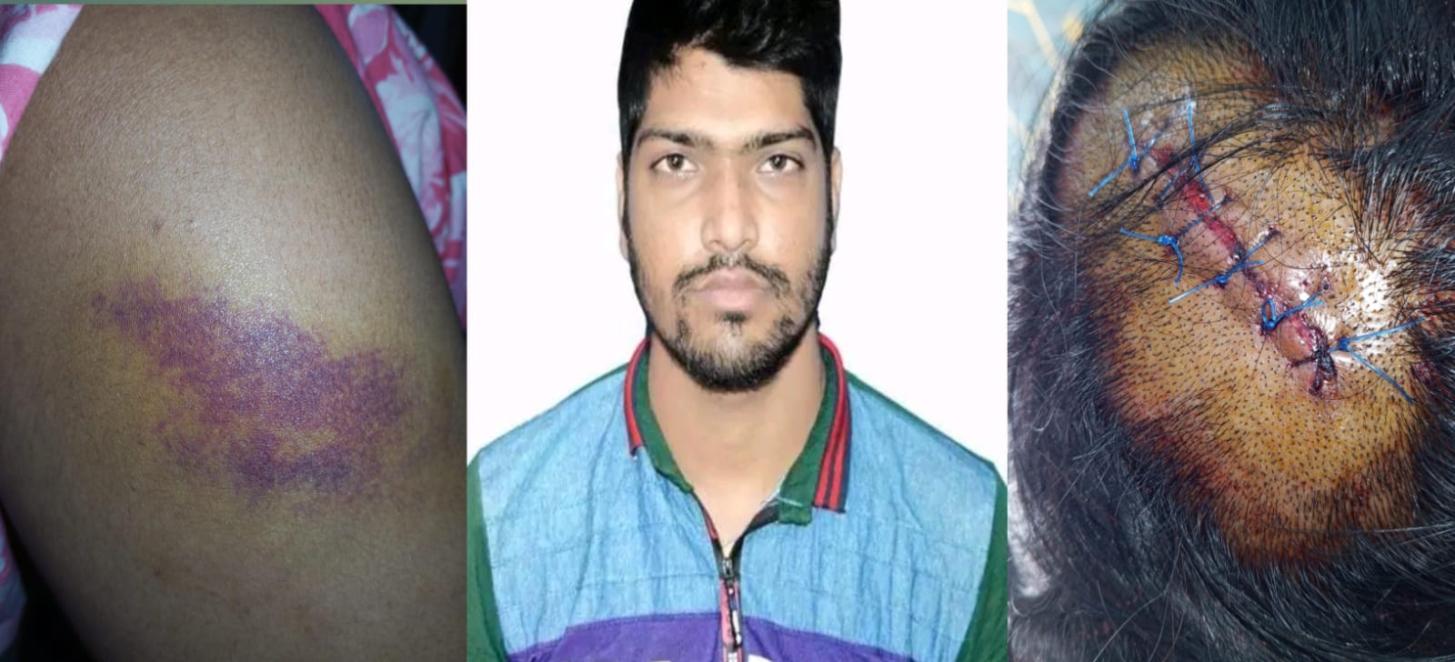 যৌতুকের দাবিতে গৃহবধূকে বেধড়ক নির্যাতন, গুরুতর জখম হয়ে হাসপাতালে ভর্তি